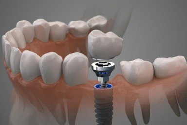 Dental implant treatment